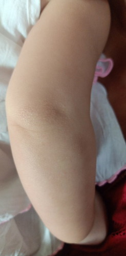 ลูกเป็นแบบนี้คล้ายๆผื่นเกิดจากอะไรหรอค่ะ