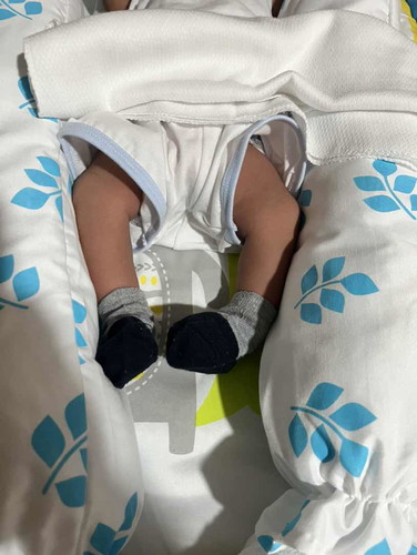 twisted foot ni baby.. 5days old