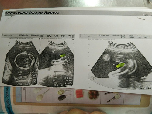 รกต่ำ อันตรายหรือป่าว