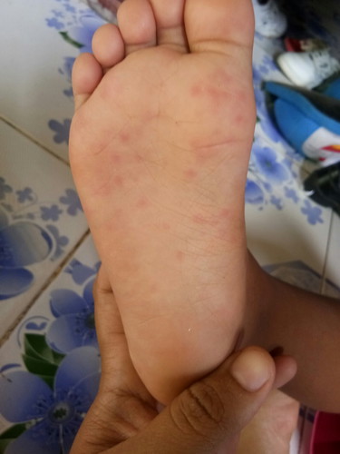 ลูกเป็นตุ่มที่เท้าแล้ววคันมากค่ะ