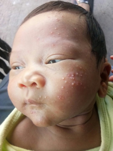 ลูกเป็นผื่นที่หน้า