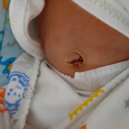 darah kering di pusar bayi
