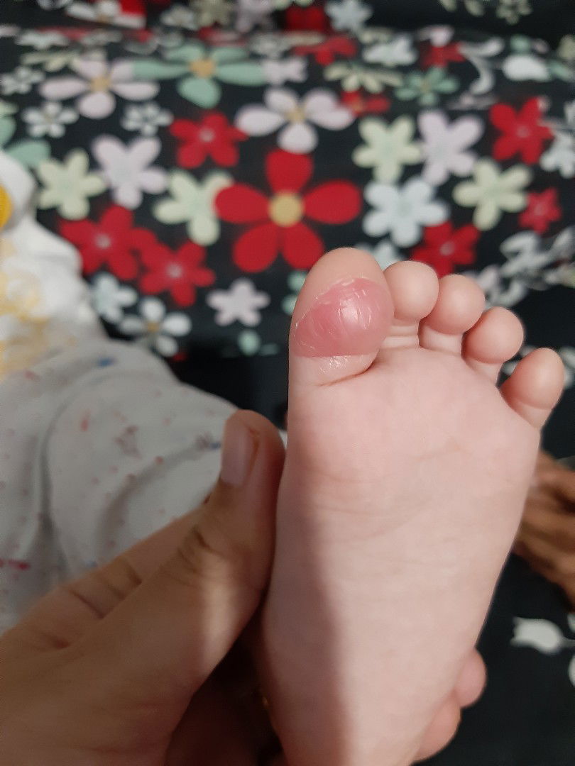 jempol kaki bayi terkelupas
