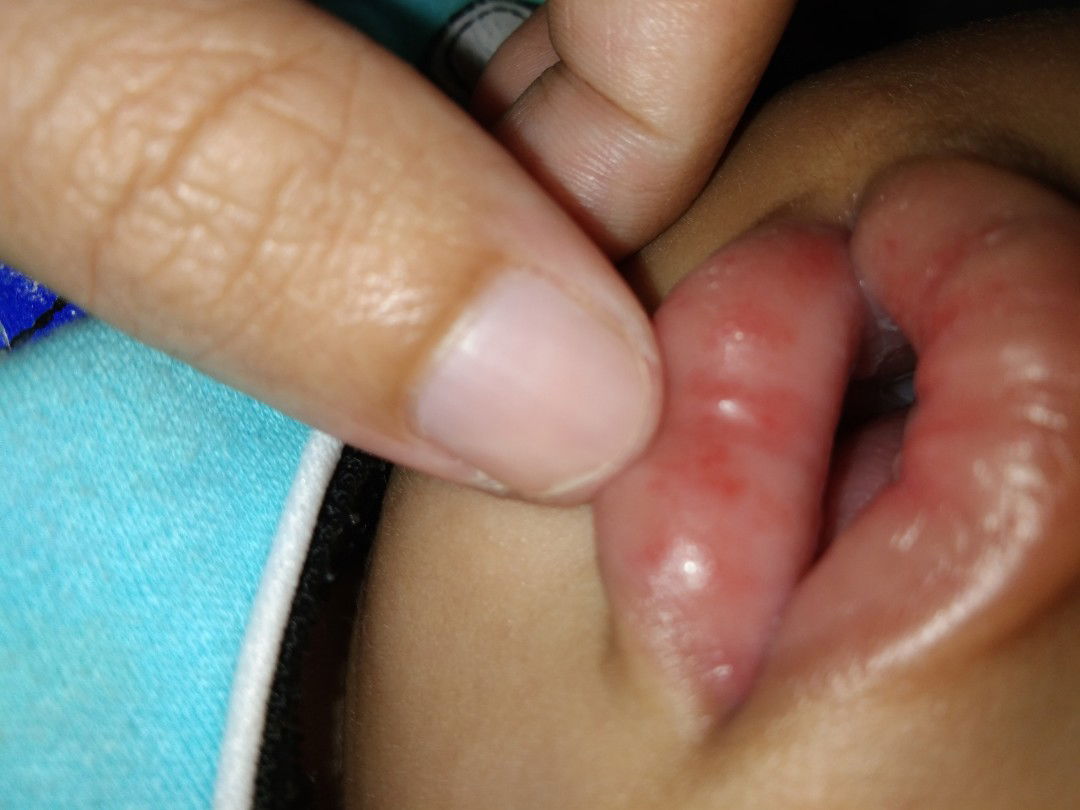 BIBIR ANAK SAYA KENAPA?