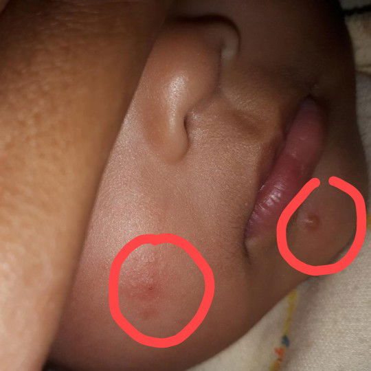 bintik merah pada bayi