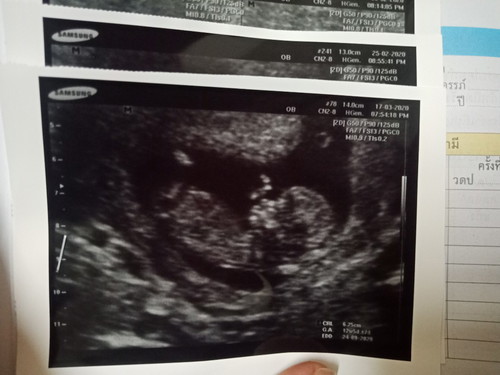 12 wk+1 d กับพาหะธาลัสซีเมียในแม่