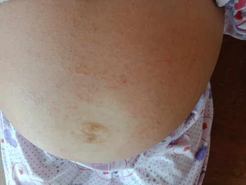 ผื่นแพ้