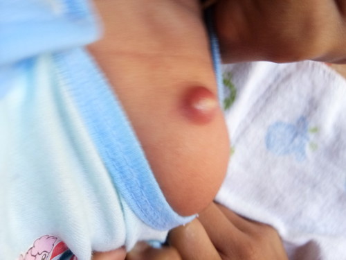 ตุ่มจากการฉีดยา