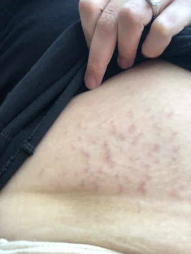 ท้องแตกลายใครเป็นมั้ง