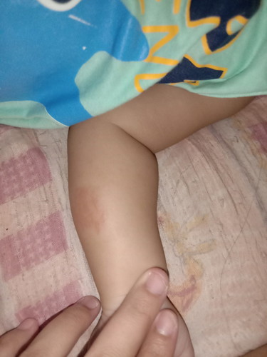 ขอสอบถามหน่อยค่ะ คือน้องเป็นผืนแดงๆที่แขนพึ่งเห็นวันนี้ น้องเป็นอะไรค่ะ