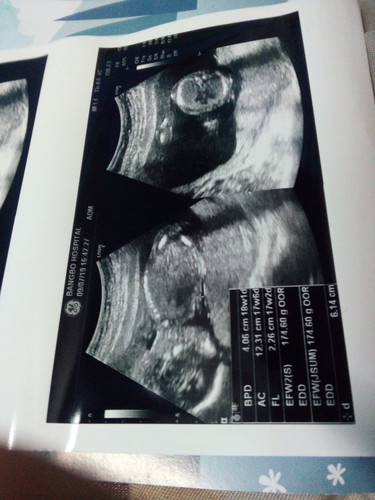 ขอดูใบอัลตราซาวด์