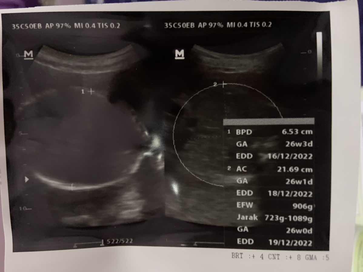Hamil 26minggu kepala janin sudah dibawah