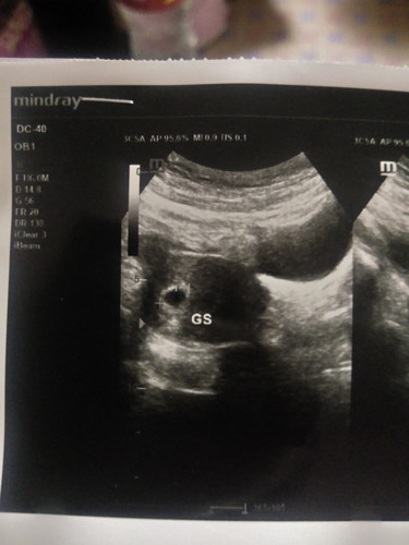 อาการแพ้ท้องหายไป