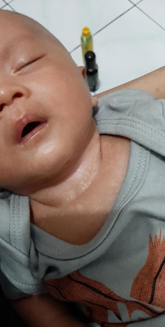 leher anak muncul bercak putih seperti panu
