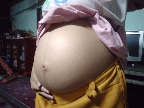 ครรภ์เป็นพิษ