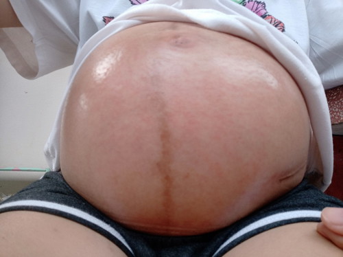 ผื่นแดง