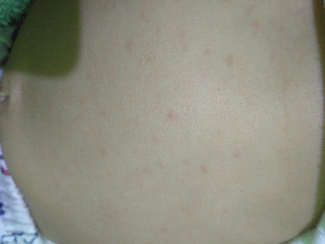 Bintik2 Merah Dibadan