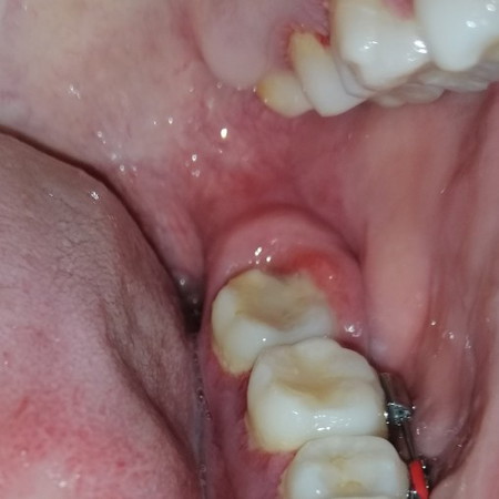Swollen gums