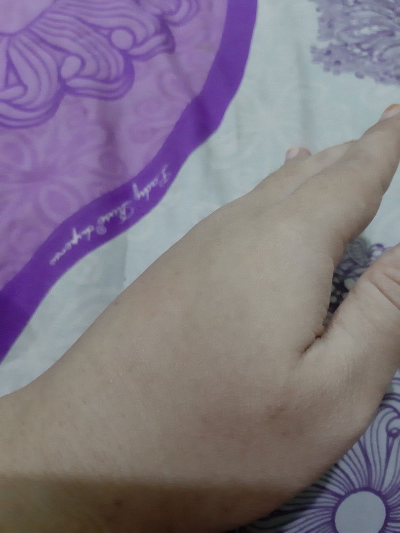 Bengkak karena Gagal Masuk Jarum Infus