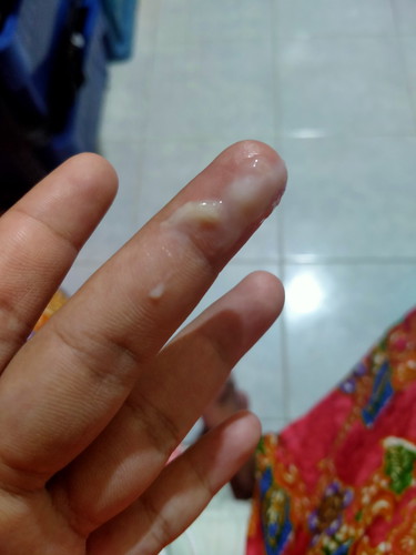 อายุครรภ์39w6d มีแบบนี้ออกมา