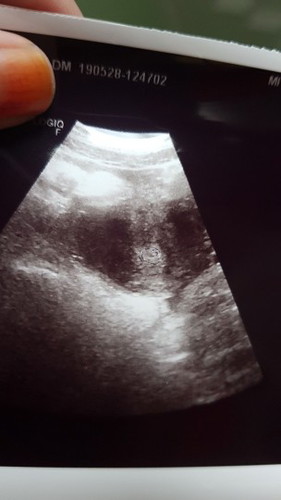 usg 6 weeks dari hpht ada yg paham gak?