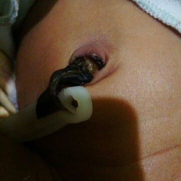 tali pusar bernanah dan berdarah