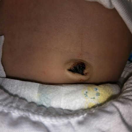 Umbilical Cord Falls off