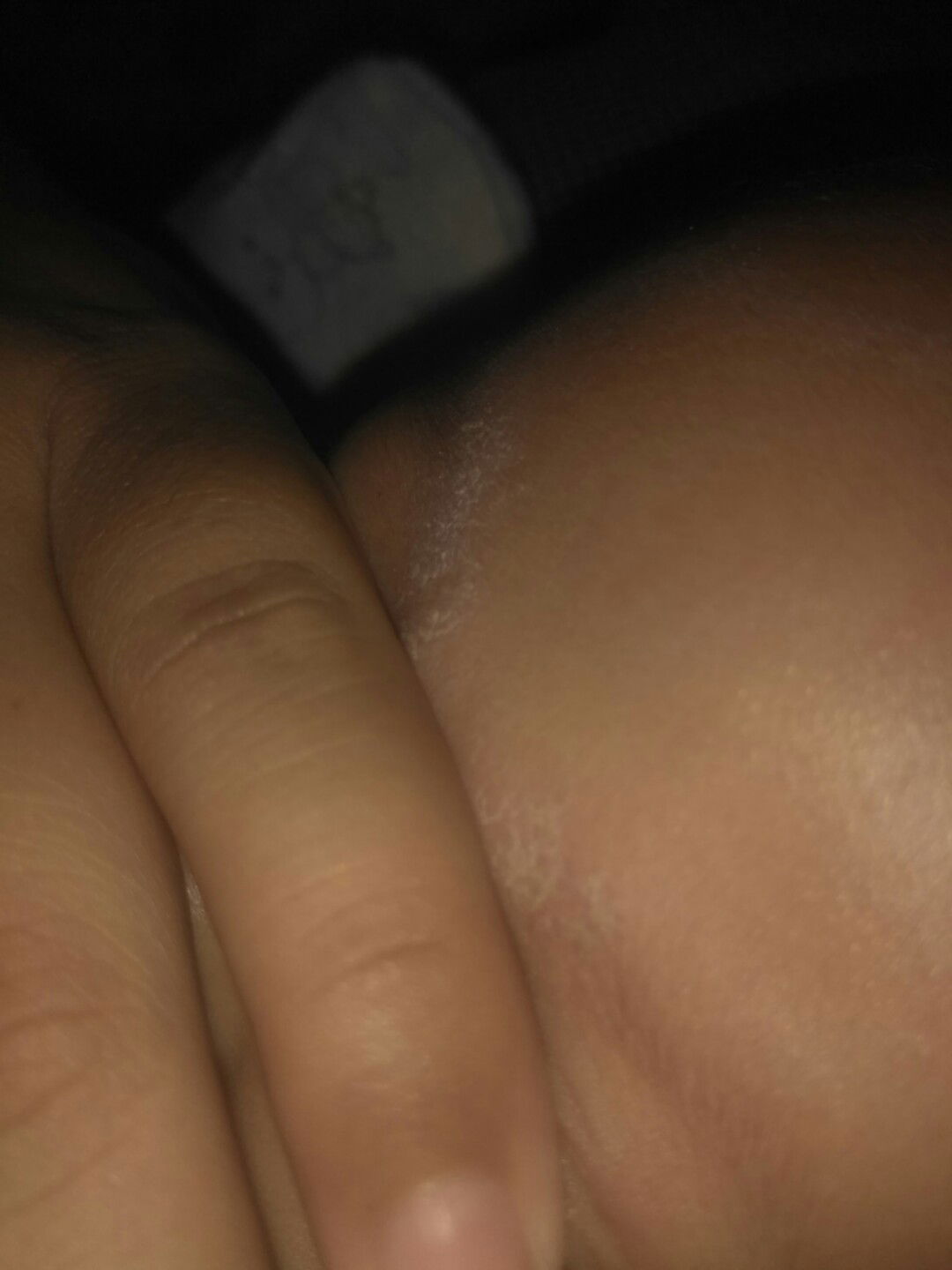 KULIT BAYI KERING BERSISIK