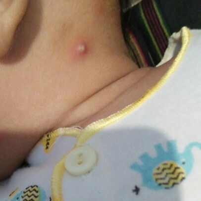 BISUL PADA KEPALA BAYI USIA 2 BULAN