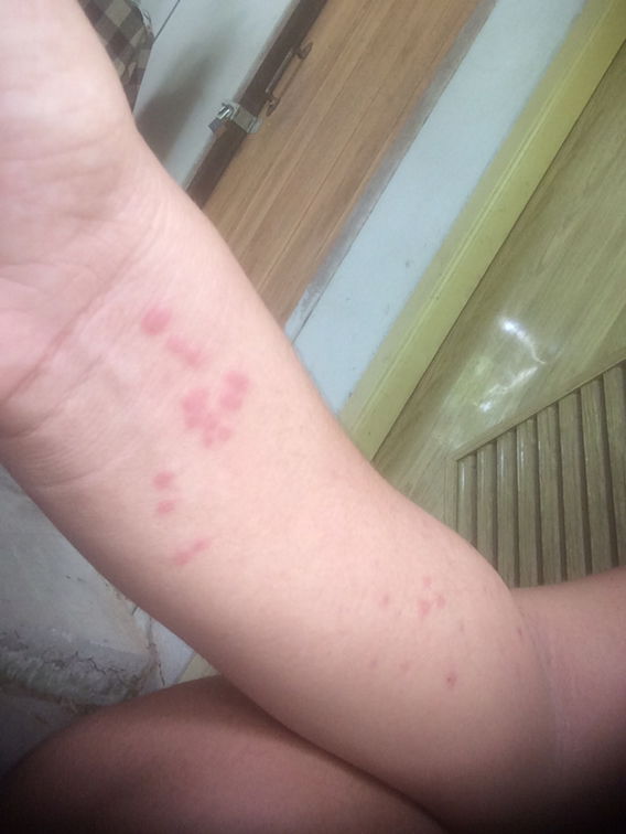 ผื่นแดงขึ้นที่เเขนเหมือนเเพ้อะไรสักอย่าง