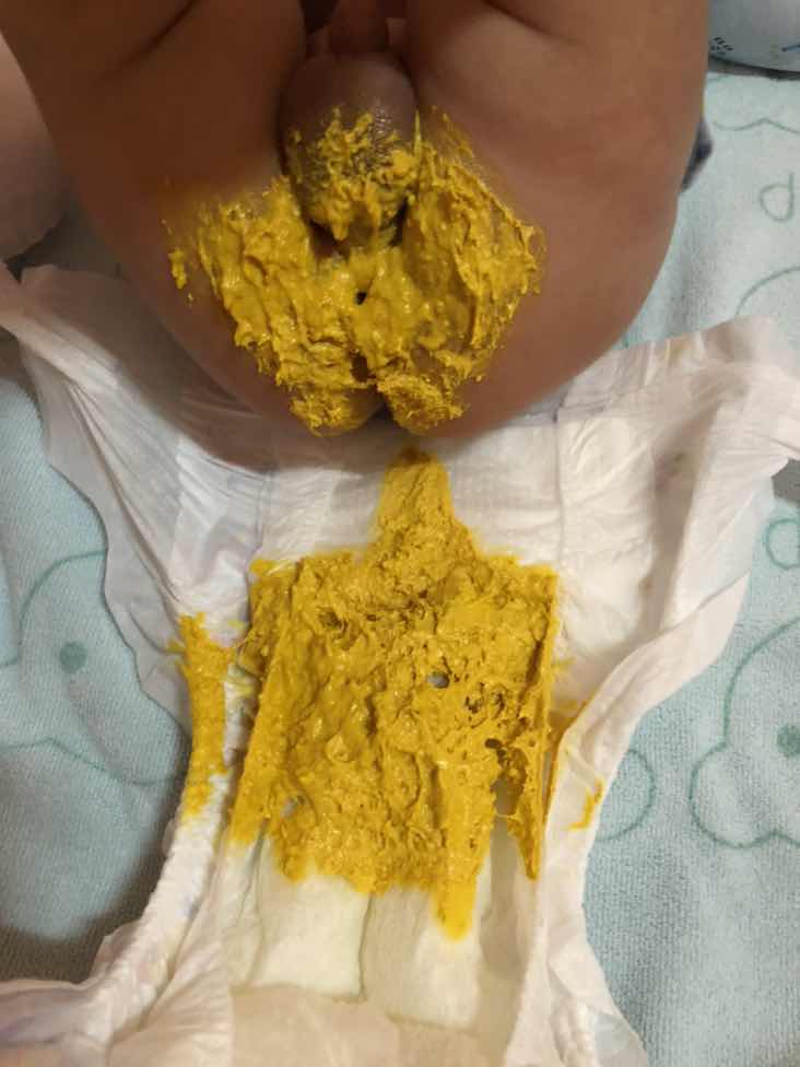 ลูกน้อยถ่ายยาก