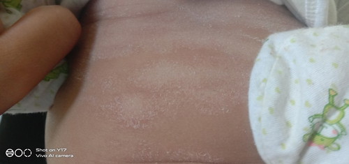 ผิวเป็นขุย