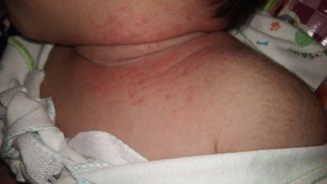 kulit bayi bruntusan