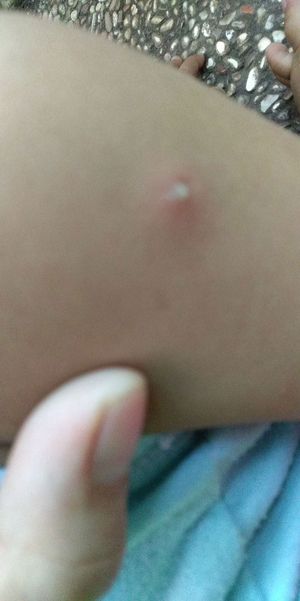 bekas BCG bernanah lagi