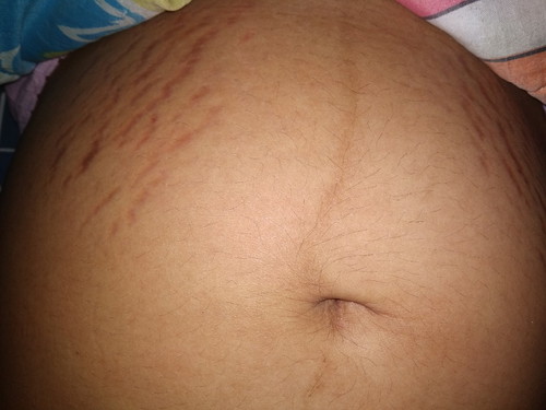 มีใครท้องแตกลายเท่านี้บ้างค่ะ