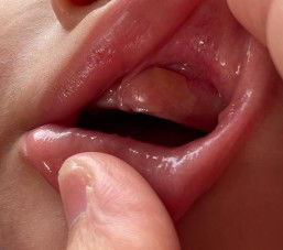 Gusi bengkak tumbuh gigi