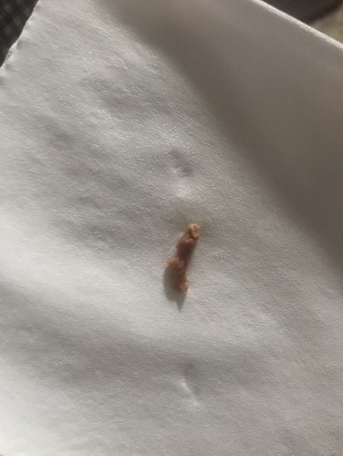 Kluar keputihan ngegumpal