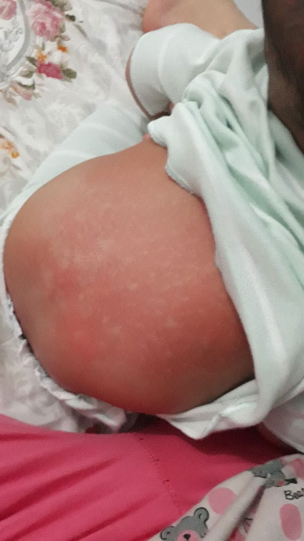 kemerahan di punggung bayi 5 bulan