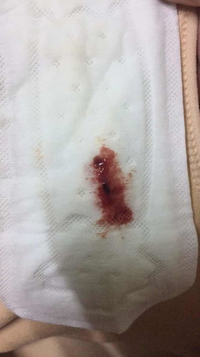 มูกเลือด