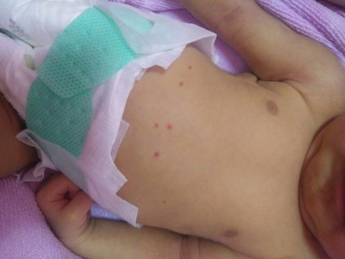 ผื่นแดง