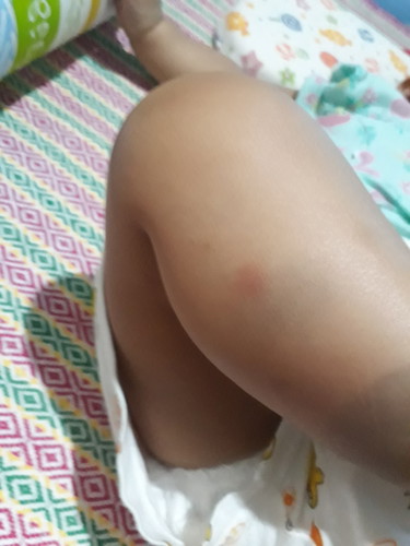 รอยดำจากยุง(แพ้ยุง)