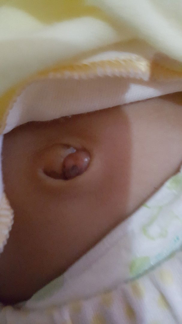 granuloma umbilikalis