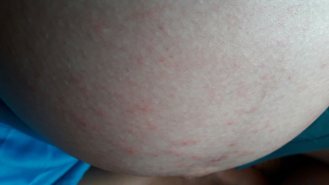 มีตุ่มแดงๆๆ