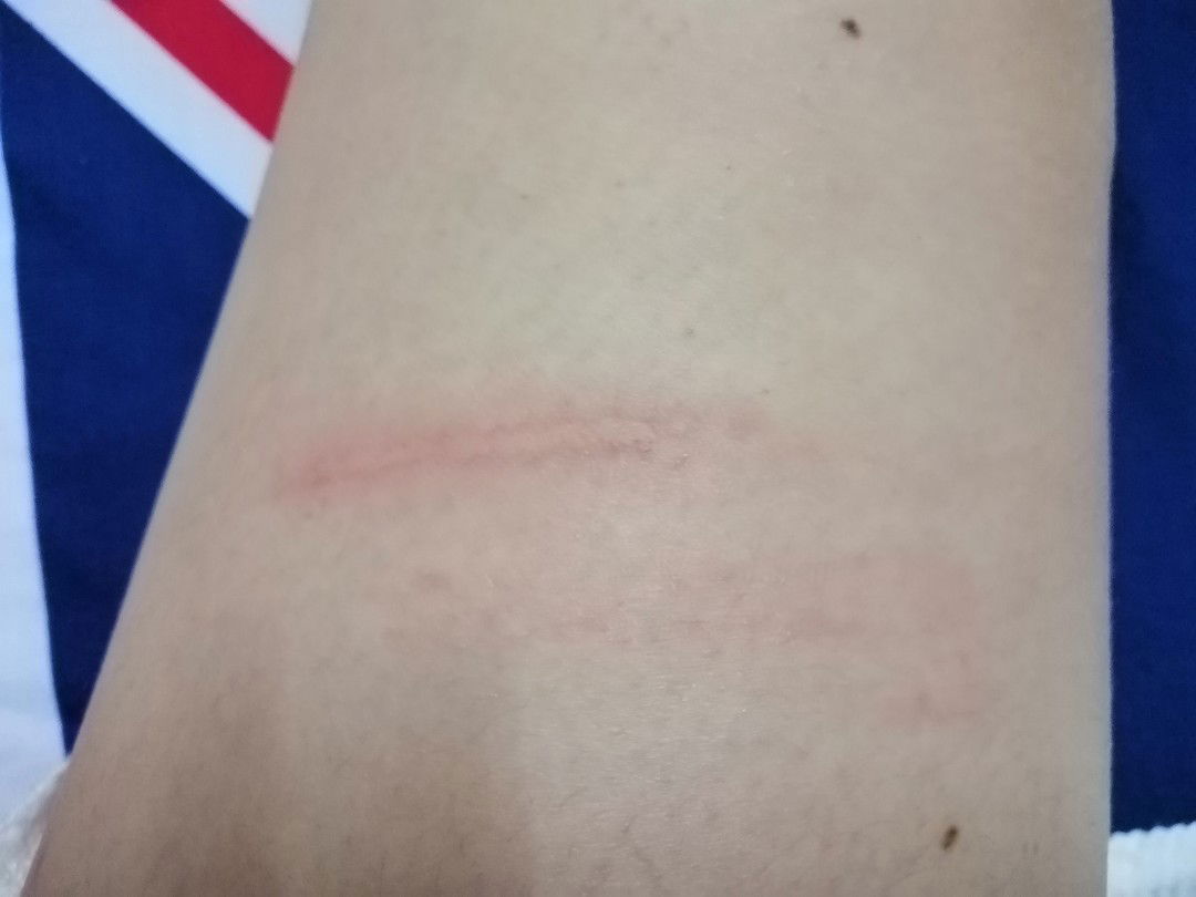 เตือนคุณแม่ระวังกันด้วยนะคะ แมลงก้นกระดก