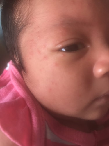 ผื่นที่หน้าน้อง