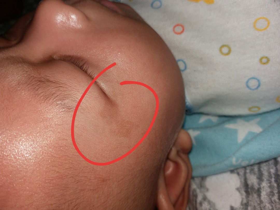 bercak hitam diujung mata kanan