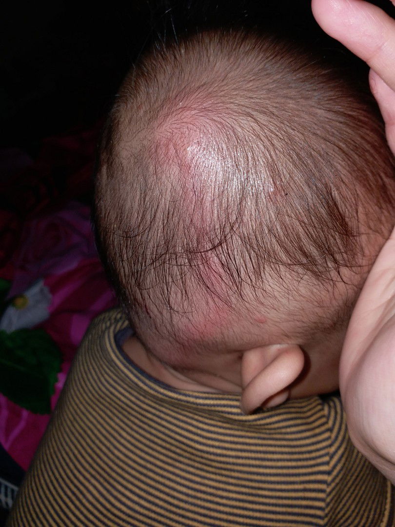 benjolan di kepala belakang telinga