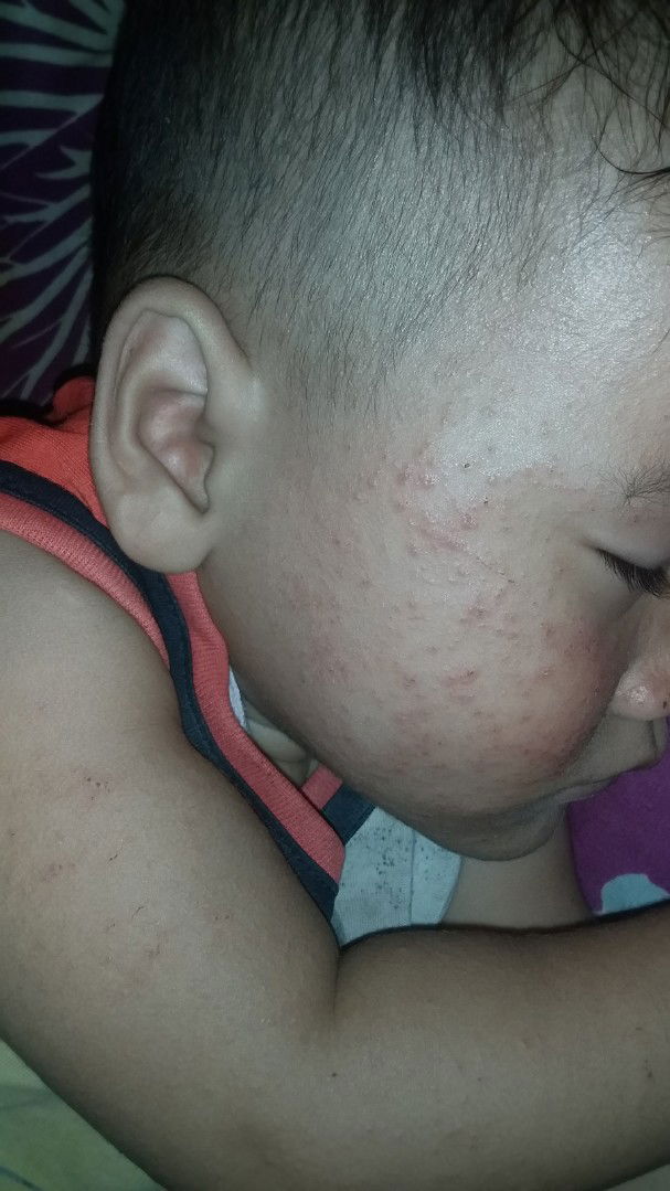 bintik2 merah diseluruh badan