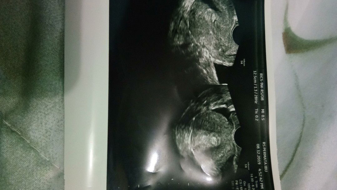 keguguran di hamil 6w3d