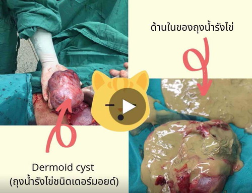 ประสบการณ์แท้งคุกคามและเป็นซีสที่ปีกมดลูกขณะตั้งครรภ์